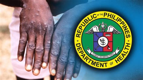 callcenter@doh.gov.ph|DOH releases updated guidelines for mpox prevention, detection, .
